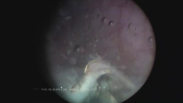 膀胱癌水刀剝離術 (bt-esd) 膀胱癌水刀剝離術 (bt-esd)