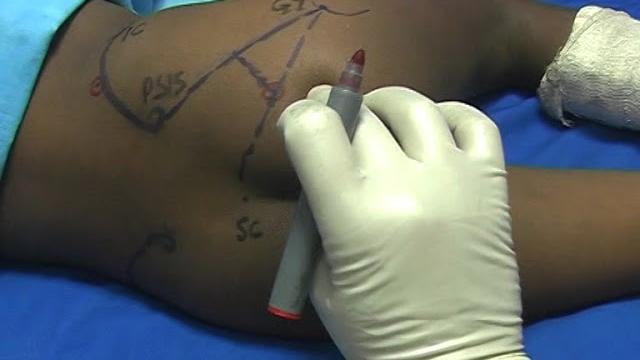 Pediatric psoas compartment & sciatic n block Pediatric psoas compartment & sciatic n block
