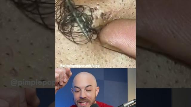 Monsterous ingrown hair #ingrownhair #doctorreacts Monsterous ingrown hair #ingrownhair #doctorreacts