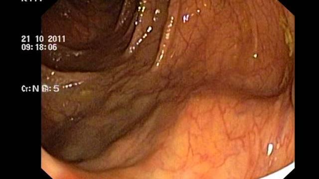 Ascaridosis on colonoscopy. аскариды при колоноскопии Ascaridosis on colonoscopy. аскариды при колоноскопии