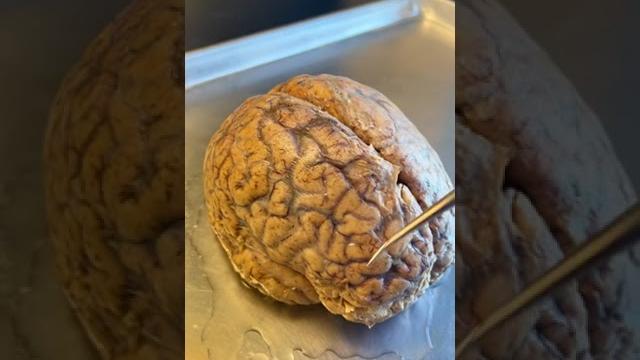 Infections on the human brain Infections on the human brain