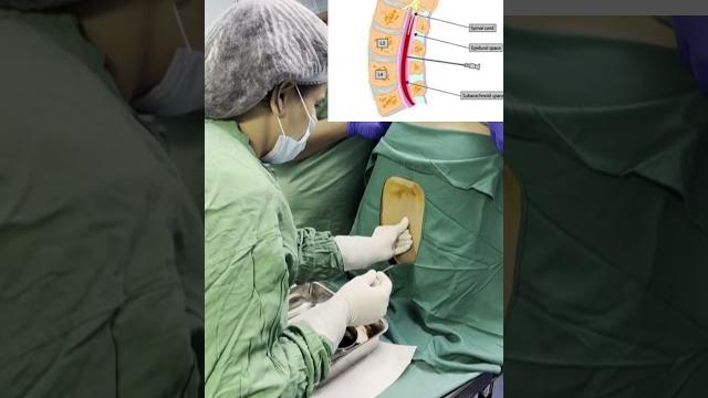 Spinal anesthesia procedure #doctor #mbbs #anesthesia #neet #medical #medicalstudent #medico #short Spinal anesthesia procedure #doctor #mbbs #anesthesia #neet #medical #medicalstudent #medico #short