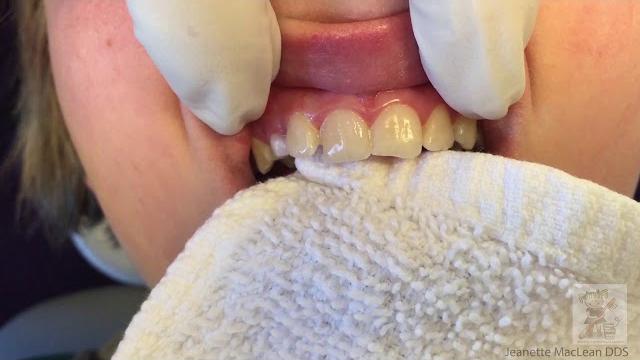 Icon resin infiltration minimally invasive dentistry protocol white spot lesions and enamel defects Icon resin infiltration minimally invasive dentistry protocol white spot lesions and enamel defects