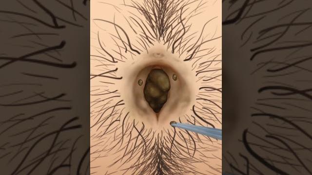 You won't believe what we pulled out of her belly button #asmr #asmrsounds #asmrvideo #satisfying You won't believe what we pulled out of her belly button #asmr #asmrsounds #asmrvideo #satisfying