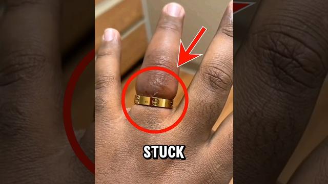 How to remove a ring stuck on finger How to remove a ring stuck on finger
