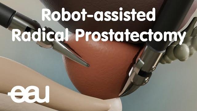 Robot-assisted radical prostatectomy (rarp) Robot-assisted radical prostatectomy (rarp)