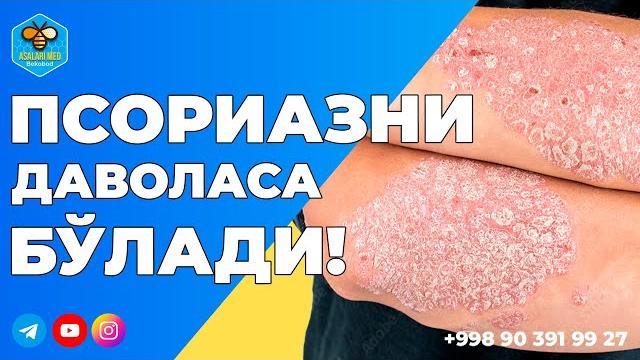 Псориаз энди муаммо эмас! псориазни даволаса бўлади!#psoriasis #psoriaznidavosi #psoriaznidavolash Псориаз энди муаммо эмас! псориазни даволаса бўлади!#psoriasis #psoriaznidavosi #psoriaznidavolash
