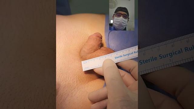 Penile enlargement surgery - penis surgery - dr . araz bayramov Penile enlargement surgery - penis surgery - dr . araz bayramov