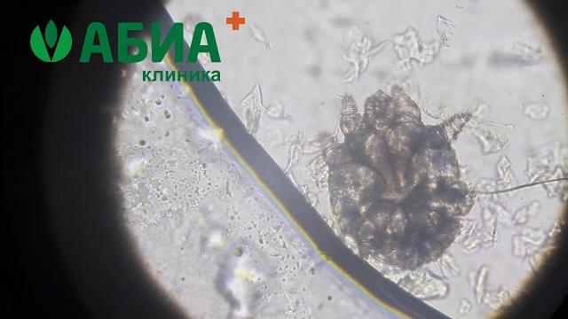 Чесоточный клещ Чесоточный клещ
