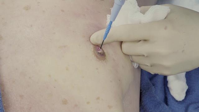 Male nipple reduction surgery for pointy protruding puffy nipples, long island, ny by dr. lebowitz Male nipple reduction surgery for pointy protruding puffy nipples, long island, ny by dr. lebowitz