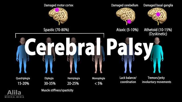Cerebral palsy, animation Cerebral palsy, animation