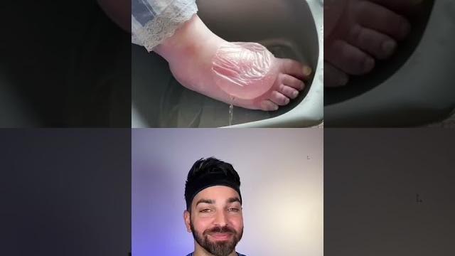 Biggest blister i’ve seen | doctorly #shorts Biggest blister i’ve seen | doctorly #shorts