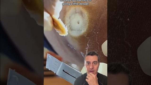 Satisfying foot wart removal! Satisfying foot wart removal!