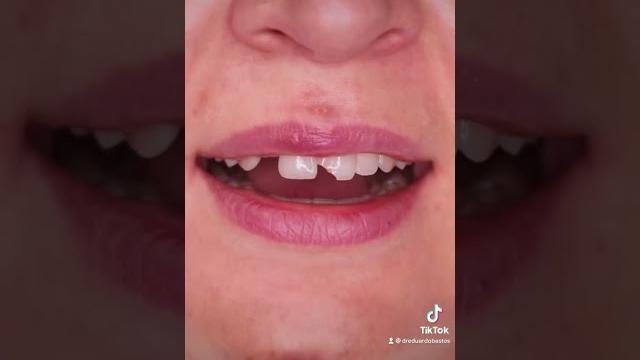 3 razões para colocar facetas dentárias 3 razões para colocar facetas dentárias