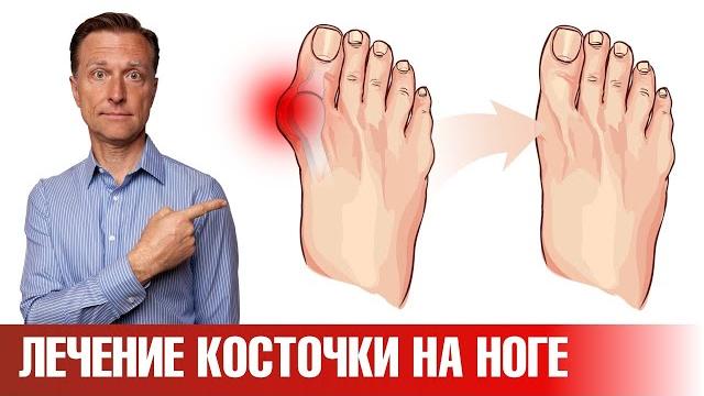 Эти 5 упражнений помогут убрать косточку на большом пальце ноги Эти 5 упражнений помогут убрать косточку на большом пальце ноги