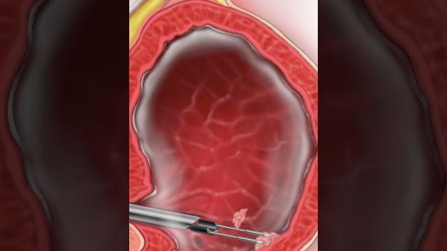 Turbt: transurethral resection of bladder tumor - why is it done? #bladdercancer #surgery #shorts Turbt: transurethral resection of bladder tumor - why is it done? #bladdercancer #surgery #shorts
