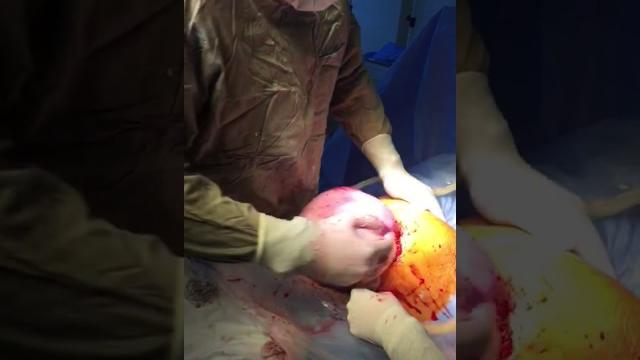 Редкие кадры , кесарево сечение Редкие кадры , кесарево сечение