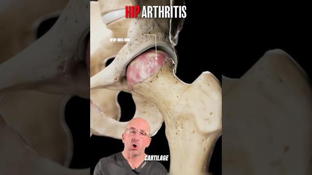 Shocking look at hip arthritis damage⁉️ Shocking look at hip arthritis damage⁉️