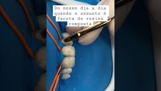 Faceta de resina composta com cuidado e com isolamento absoluto! #dentistas #facetas #dentes Faceta de resina composta com cuidado e com isolamento absoluto! #dentistas #facetas #dentes