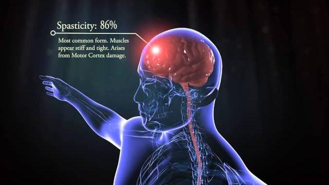 Types of cerebral palsy Types of cerebral palsy