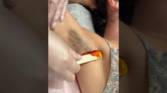Satisfying underarm hair removal #waxing #hairremoval #satisfying #wax #asmrwax #asmrsounds #asmr Satisfying underarm hair removal #waxing #hairremoval #satisfying #wax #asmrwax #asmrsounds #asmr
