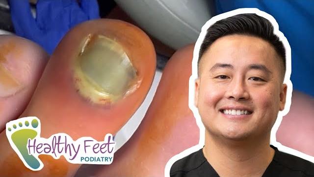 A toe squirt, a foot cyst, and more! A toe squirt, a foot cyst, and more!