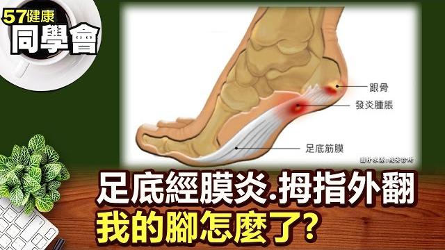 足底經膜炎.拇指外翻 我的腳怎麼了?【57健康同學會】第065集-2010年 足底經膜炎.拇指外翻 我的腳怎麼了?【57健康同學會】第065集-2010年