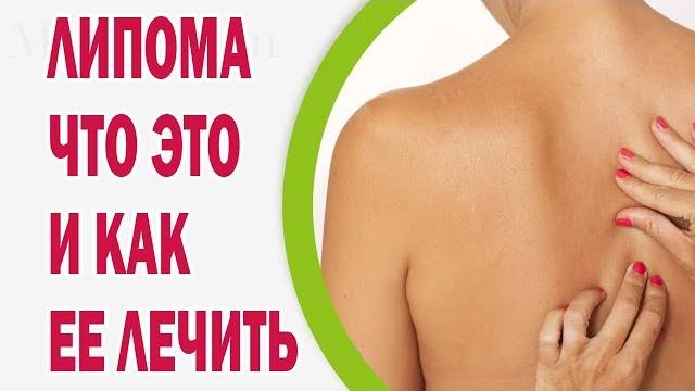 Липома - что это такое и как ее лечить Липома - что это такое и как ее лечить
