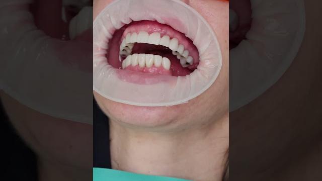 Dental implant’s all on 4 in prague #shorts #dentist #dental #implant #veneers #short Dental implant’s all on 4 in prague #shorts #dentist #dental #implant #veneers #short