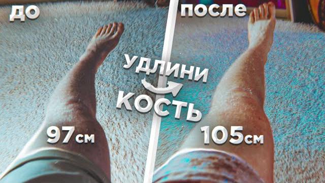 Кости растут в любом возрасте! увеличение роста без операции . кость растёт после закрытия зон. Кости растут в любом возрасте! увеличение роста без операции . кость растёт после закрытия зон.