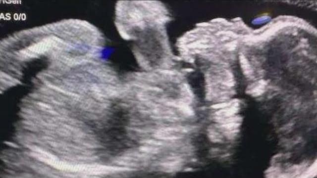 Baby born after brain-dead georgia mom to be taken off life support today after four months Baby born after brain-dead georgia mom to be taken off life support today after four months