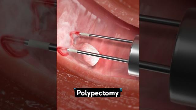 Removing a polyp from your uterus (3d animation) Removing a polyp from your uterus (3d animation)