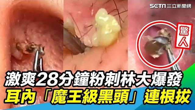 28分鐘激爽片!粉刺林、巨痘大爆發 耳內「魔王級黑頭」連根拔起|@setn 28分鐘激爽片!粉刺林、巨痘大爆發 耳內「魔王級黑頭」連根拔起|@setn