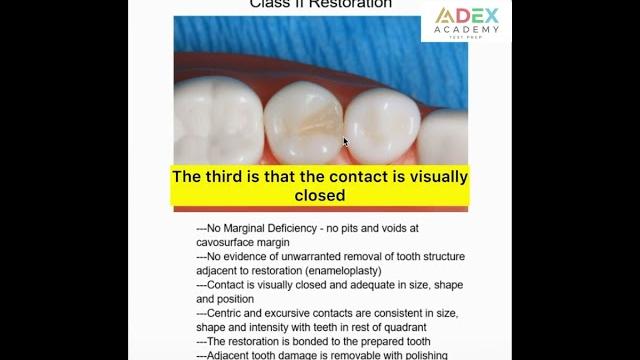 Class ii restoration requirements for adex #testprep #dentalboards #dentalexam #adexacademy #boards Class ii restoration requirements for adex #testprep #dentalboards #dentalexam #adexacademy #boards