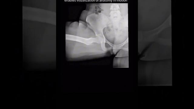 Hip & shoulder movement seen for the first-time with dynamic x-ray #jointpain #anatomy Hip & shoulder movement seen for the first-time with dynamic x-ray #jointpain #anatomy