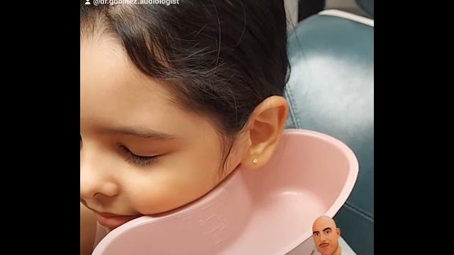 Ear wax removal (ear cleaning) Ear wax removal (ear cleaning)