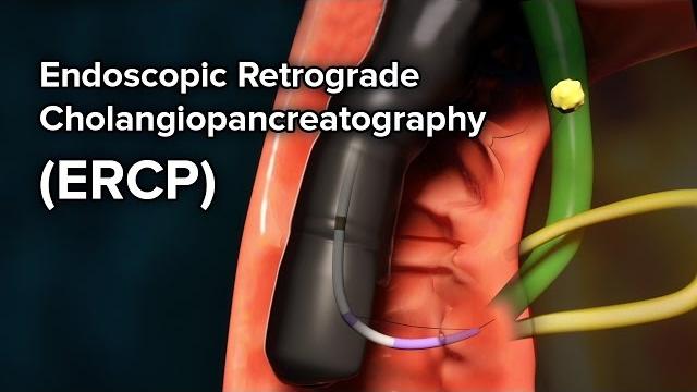 Pediatric ercp | cincinnati children's Pediatric ercp | cincinnati children's