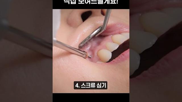 교정을 위해 잇몸에 나사를 박는다고요?!?! #shorts 교정을 위해 잇몸에 나사를 박는다고요?!?! #shorts