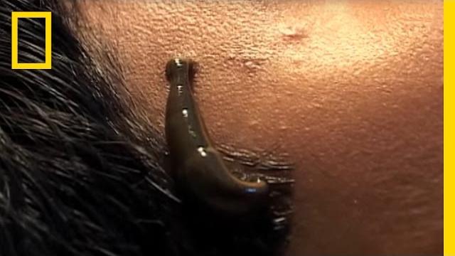 Leeches cure | national geographic Leeches cure | national geographic