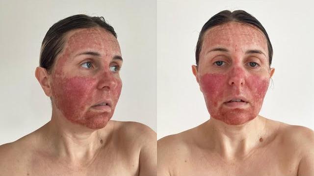 Co2 fractional laser: recovery day by day Co2 fractional laser: recovery day by day