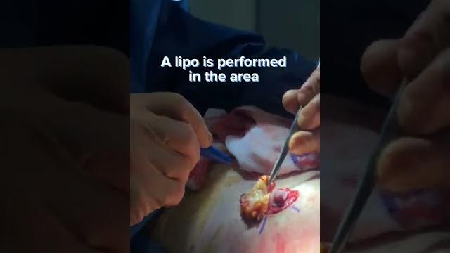 Quick view of a gland extraction by dr.castañeda #gynecomastia #gynecomastiasurgery #plasticsurgery Quick view of a gland extraction by dr.castañeda #gynecomastia #gynecomastiasurgery #plasticsurgery