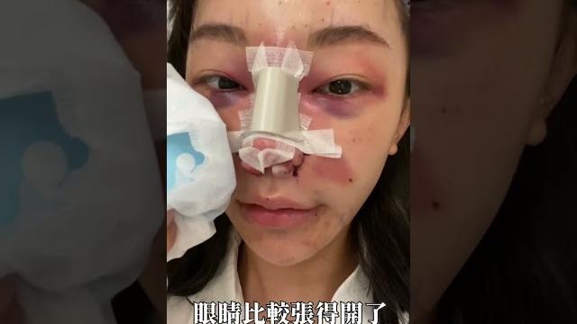 整形一個月恢復|福爾思庭 整形一個月恢復|福爾思庭