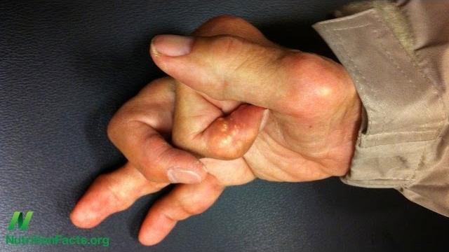 Turmeric curcumin and osteoarthritis Turmeric curcumin and osteoarthritis