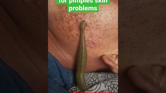 Leech therapy for skin problems #pimples #ayurveda #skinproblems #shorts #panchkarma #hairfall #mp Leech therapy for skin problems #pimples #ayurveda #skinproblems #shorts #panchkarma #hairfall #mp