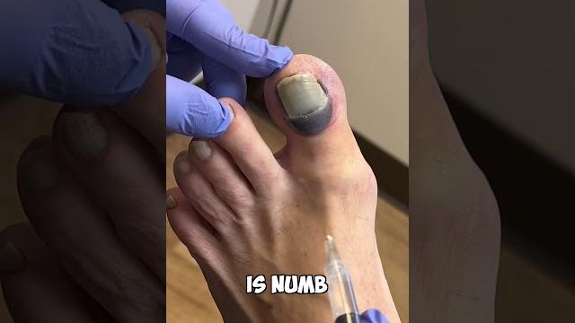 Ouch! numbing a toe: a quick fix" Ouch! numbing a toe: a quick fix"