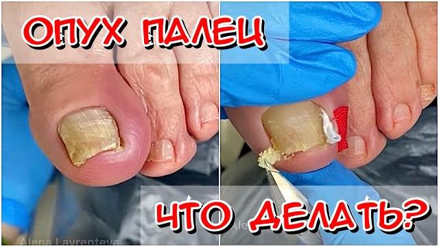 Swollen finger what to do? sore finger / ingrown toenail Swollen finger what to do? sore finger / ingrown toenail