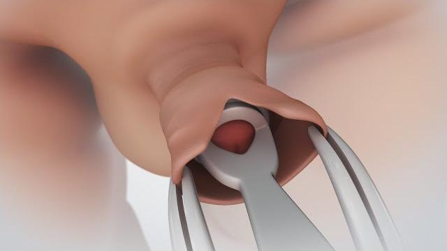 Circumcision | nucleus health Circumcision | nucleus health
