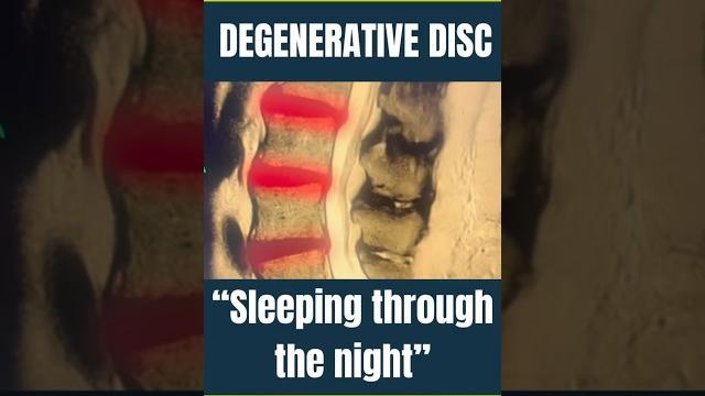Sleeping pain free after 3 weeks! #spinaldecompression #degenerativediscdisease #chiropractor #disc Sleeping pain free after 3 weeks! #spinaldecompression #degenerativediscdisease #chiropractor #disc
