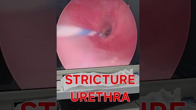 How stricture urethra look #urethralstricturetreatment #urethralstricture #strictureurethra How stricture urethra look #urethralstricturetreatment #urethralstricture #strictureurethra