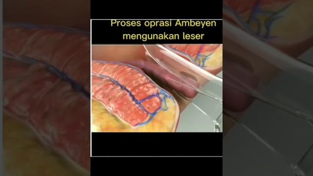 Proses operasi ambeien Proses operasi ambeien